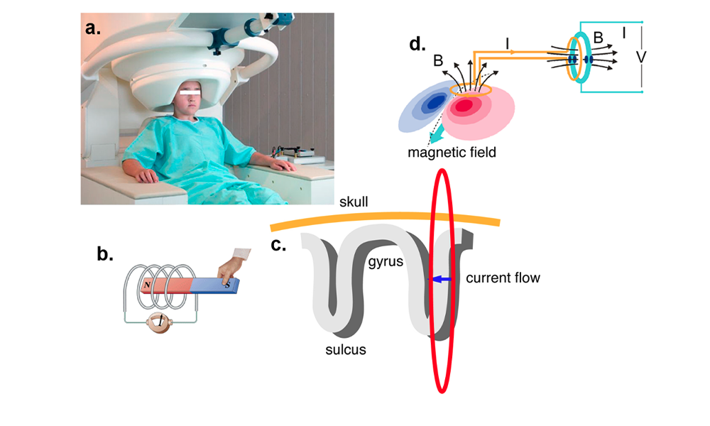 மேக்னெட்டோ என்செபலோ கிராபி